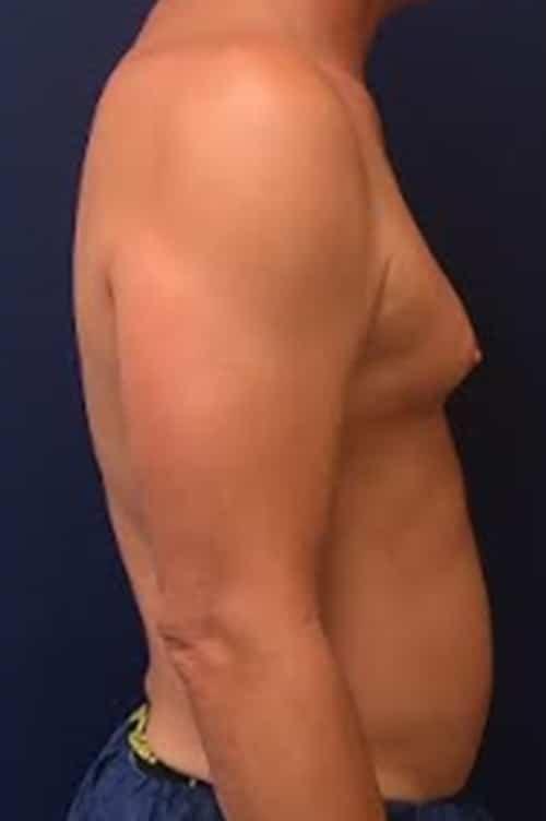 Liposuction before at Pacific Plastic Surgery Institute - Joyce Chen MD in Irvine, CA