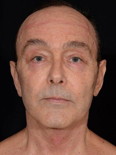 AVN Plastic Surgery facelift after — Tomball, TX