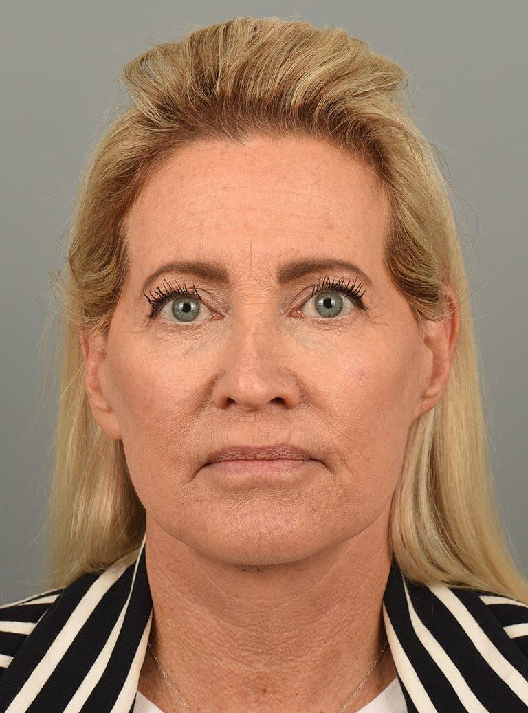 FAC Centers for Aesthetic Medicine facelift after — San Clemente, CA