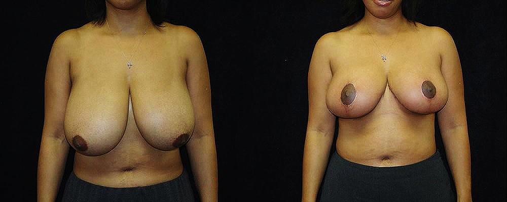 Metamorphosis Plastic Surgery breast reduction result — Ellicott City, MD
