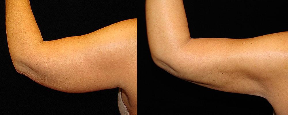 Metamorphosis Plastic Surgery arm lift result — Ellicott City, MD