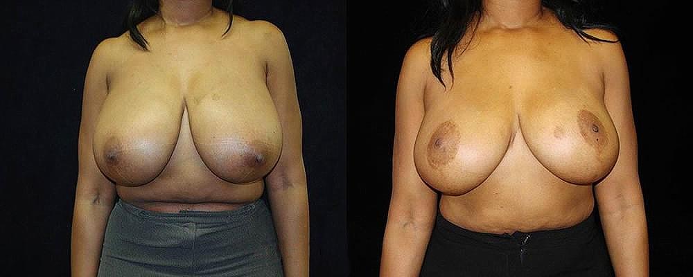 Metamorphosis Plastic Surgery breast reduction result — Ellicott City, MD