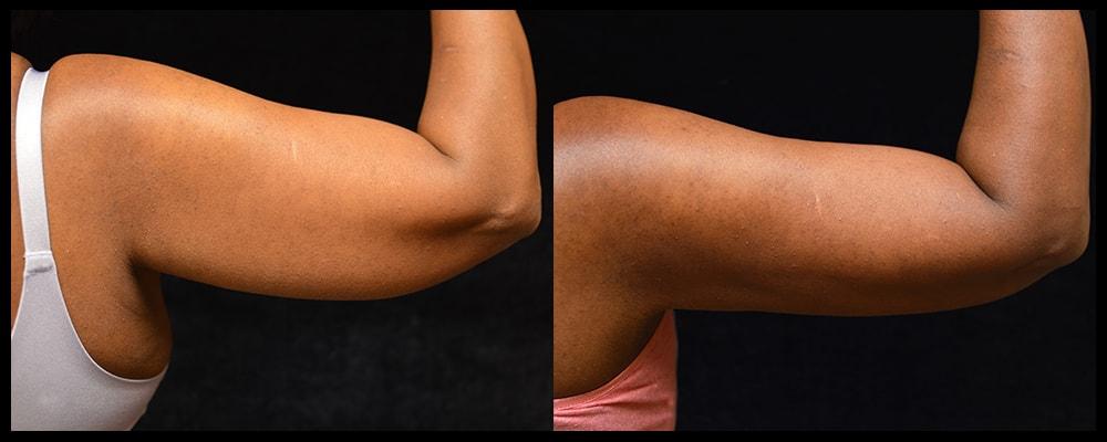 Metamorphosis Plastic Surgery arm lift result — Ellicott City, MD