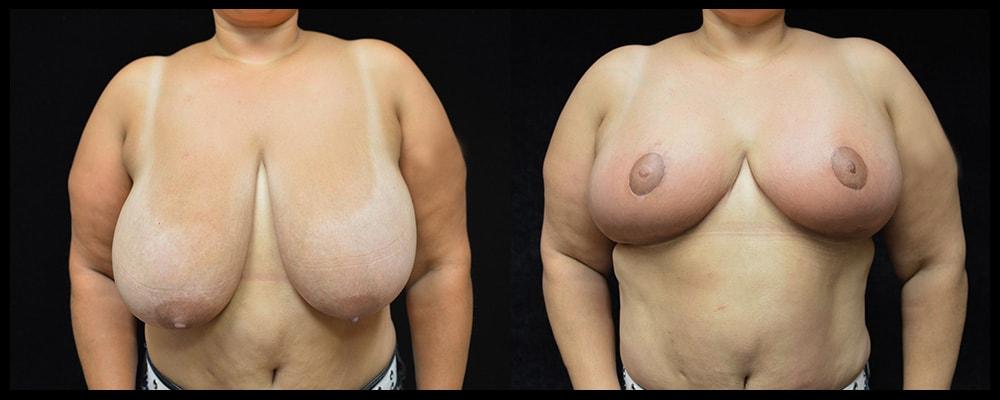 Metamorphosis Plastic Surgery breast reduction result — Ellicott City, MD