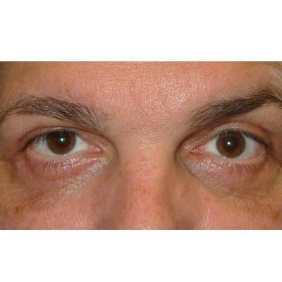 Blepharoplasty after at Daniel S. Tresley, MD in Northbrook, IL