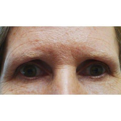 Brow Lift before at Daniel S. Tresley, MD in Northbrook, IL