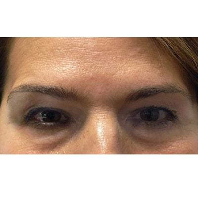 Blepharoplasty before at Daniel S. Tresley, MD in Northbrook, IL
