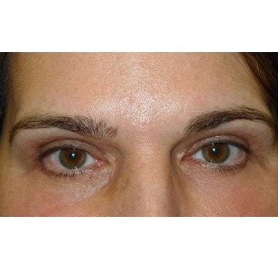 Blepharoplasty after at Daniel S. Tresley, MD in Northbrook, IL