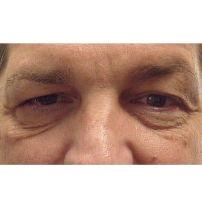 Blepharoplasty before at Daniel S. Tresley, MD in Northbrook, IL