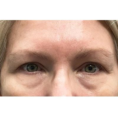 Blepharoplasty before at Daniel S. Tresley, MD in Northbrook, IL