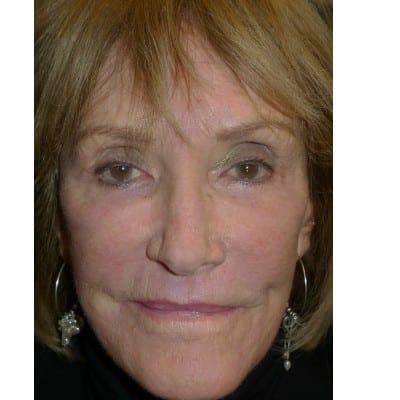 Daniel S. Tresley, MD laser treatment after — Northbrook, IL
