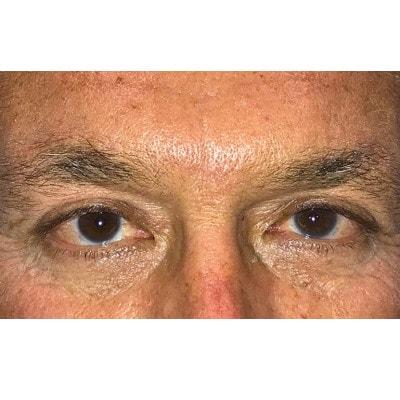 Daniel S. Tresley, MD eyelid lift after — Northbrook, IL