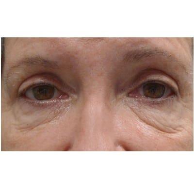 Blepharoplasty before at Daniel S. Tresley, MD in Northbrook, IL