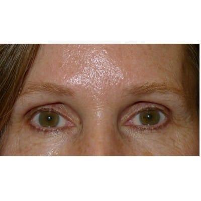 Daniel S. Tresley, MD brow lift after — Northbrook, IL