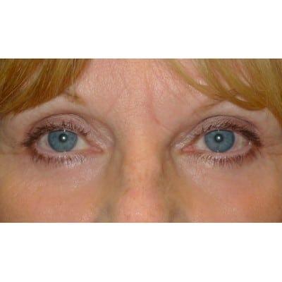 Daniel S. Tresley, MD eyelid lift after — Northbrook, IL