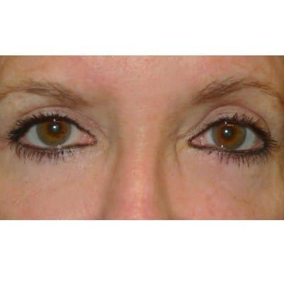 Blepharoplasty after at Daniel S. Tresley, MD in Northbrook, IL