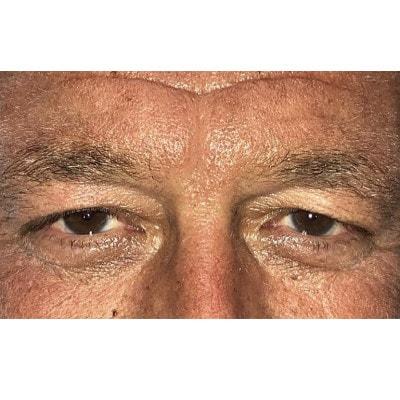 Blepharoplasty before at Daniel S. Tresley, MD in Northbrook, IL