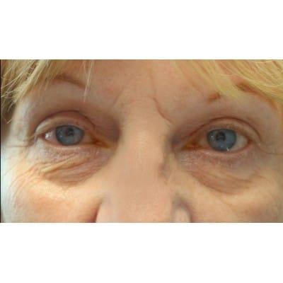 Blepharoplasty before at Daniel S. Tresley, MD in Northbrook, IL