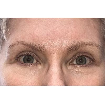 Blepharoplasty after at Daniel S. Tresley, MD in Northbrook, IL