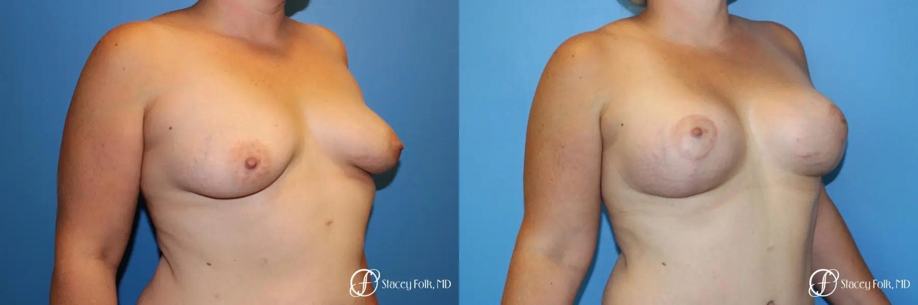 Stacey Folk, MD breast augmentation result — Denver, CO