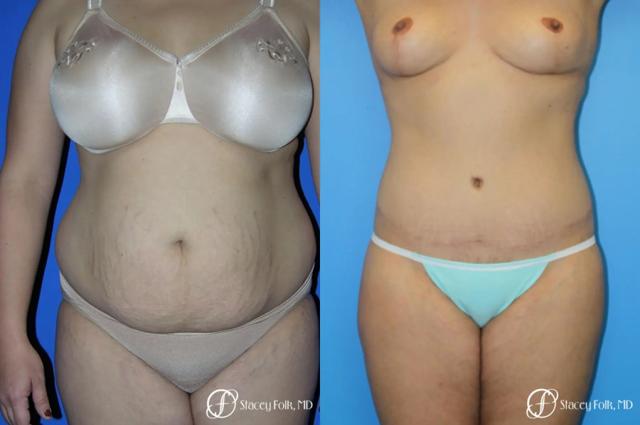 Mommy Makeover result at Stacey Folk, MD in Denver, CO