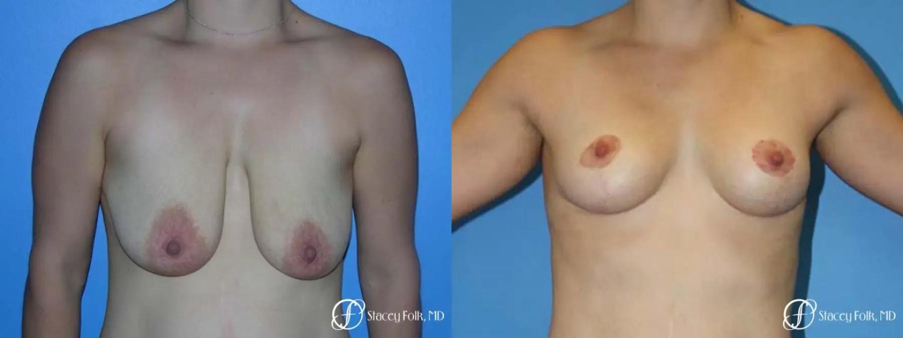 Stacey Folk, MD breast lift result — Denver, CO