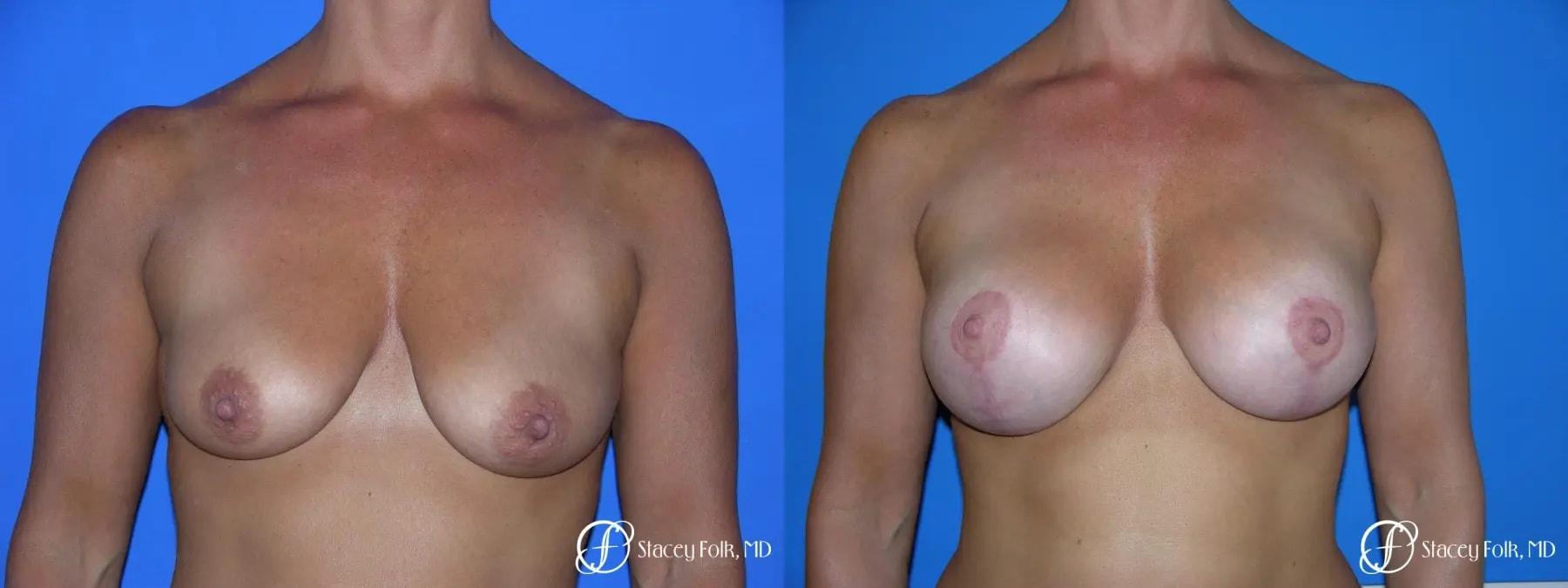 Stacey Folk, MD breast augmentation result — Denver, CO