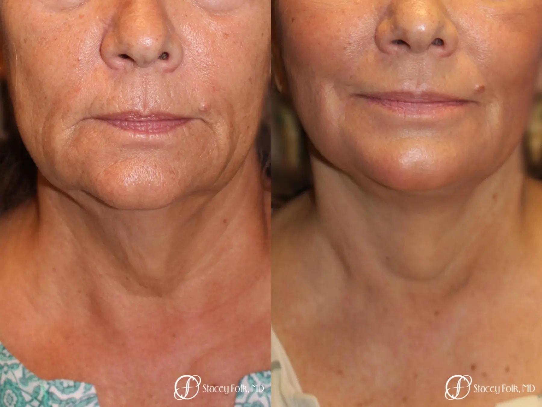 Stacey Folk, MD facelift result — Denver, CO