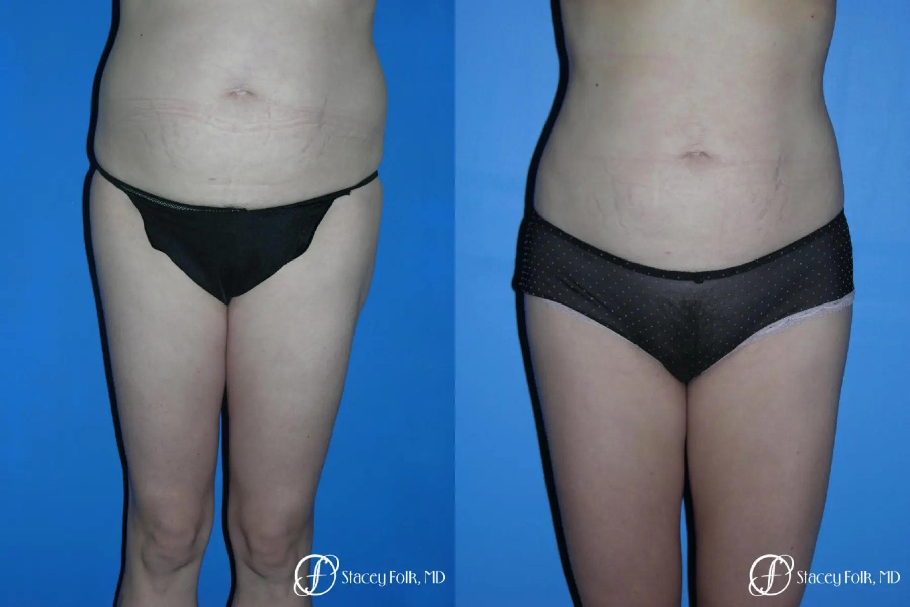 Stacey Folk, MD liposuction result — Denver, CO