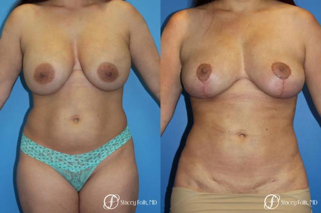 Mommy Makeover result at Stacey Folk, MD in Denver, CO