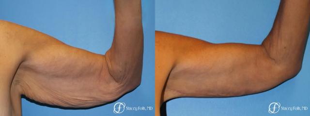 Arm Lift result at Stacey Folk, MD in Denver, CO