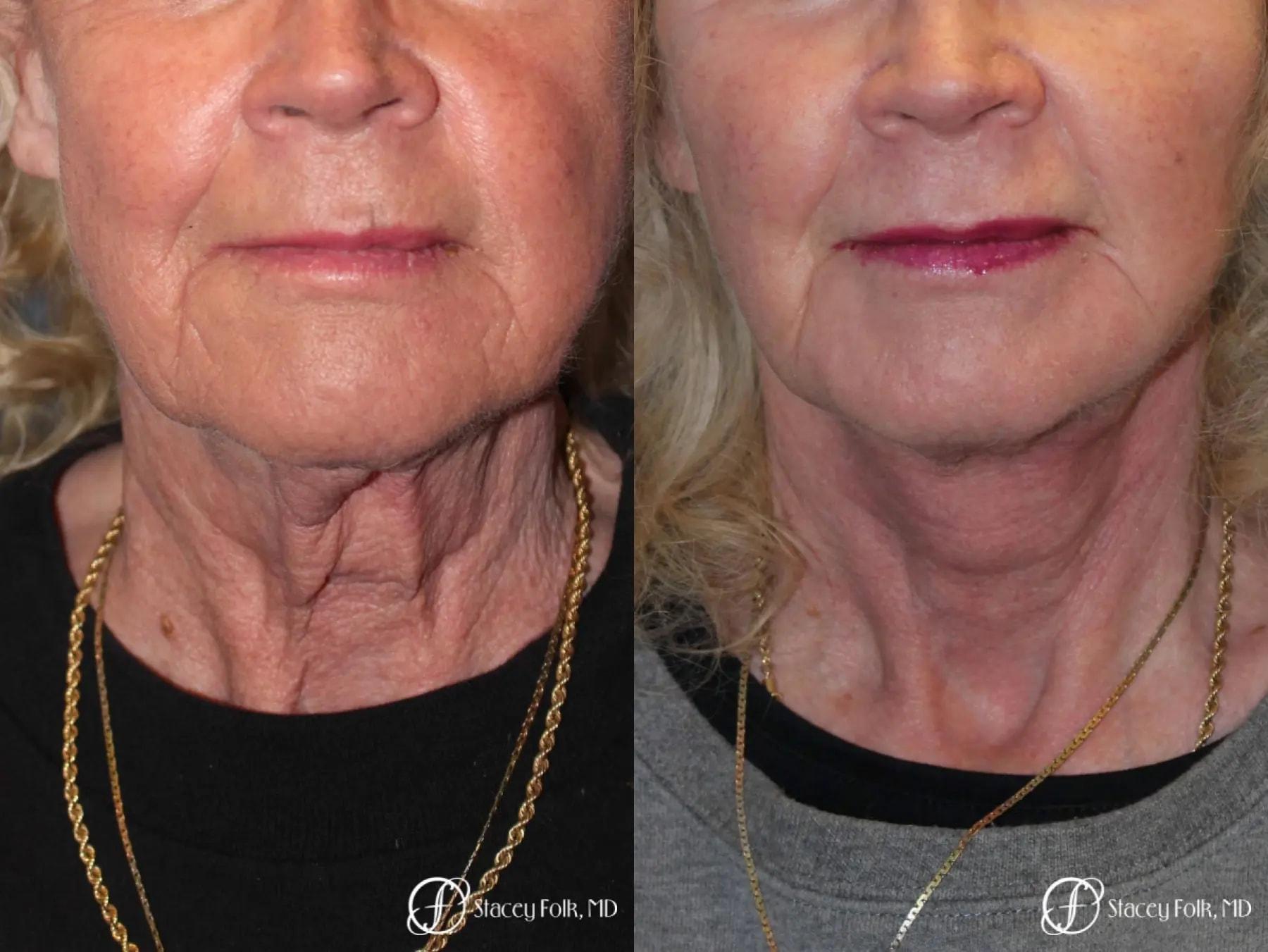 Stacey Folk, MD facelift result — Denver, CO