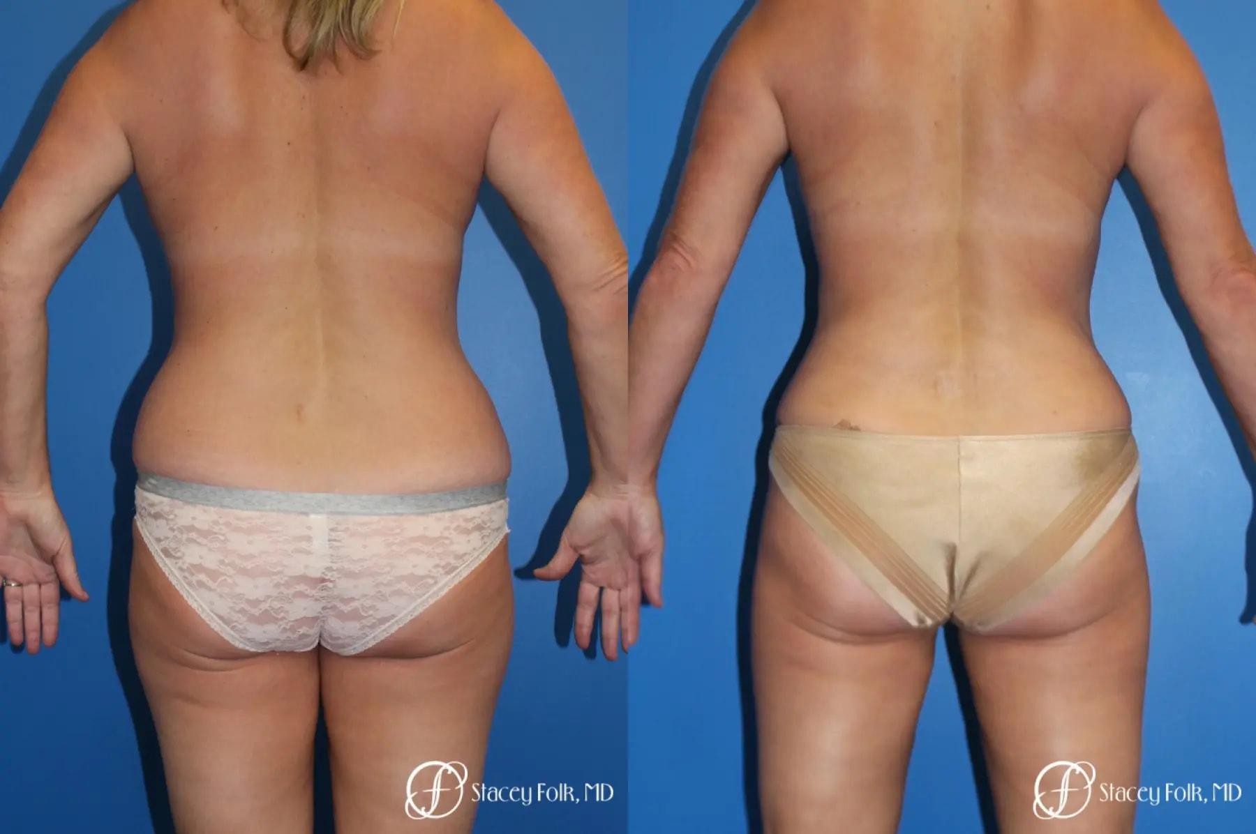 Stacey Folk, MD liposuction result — Denver, CO