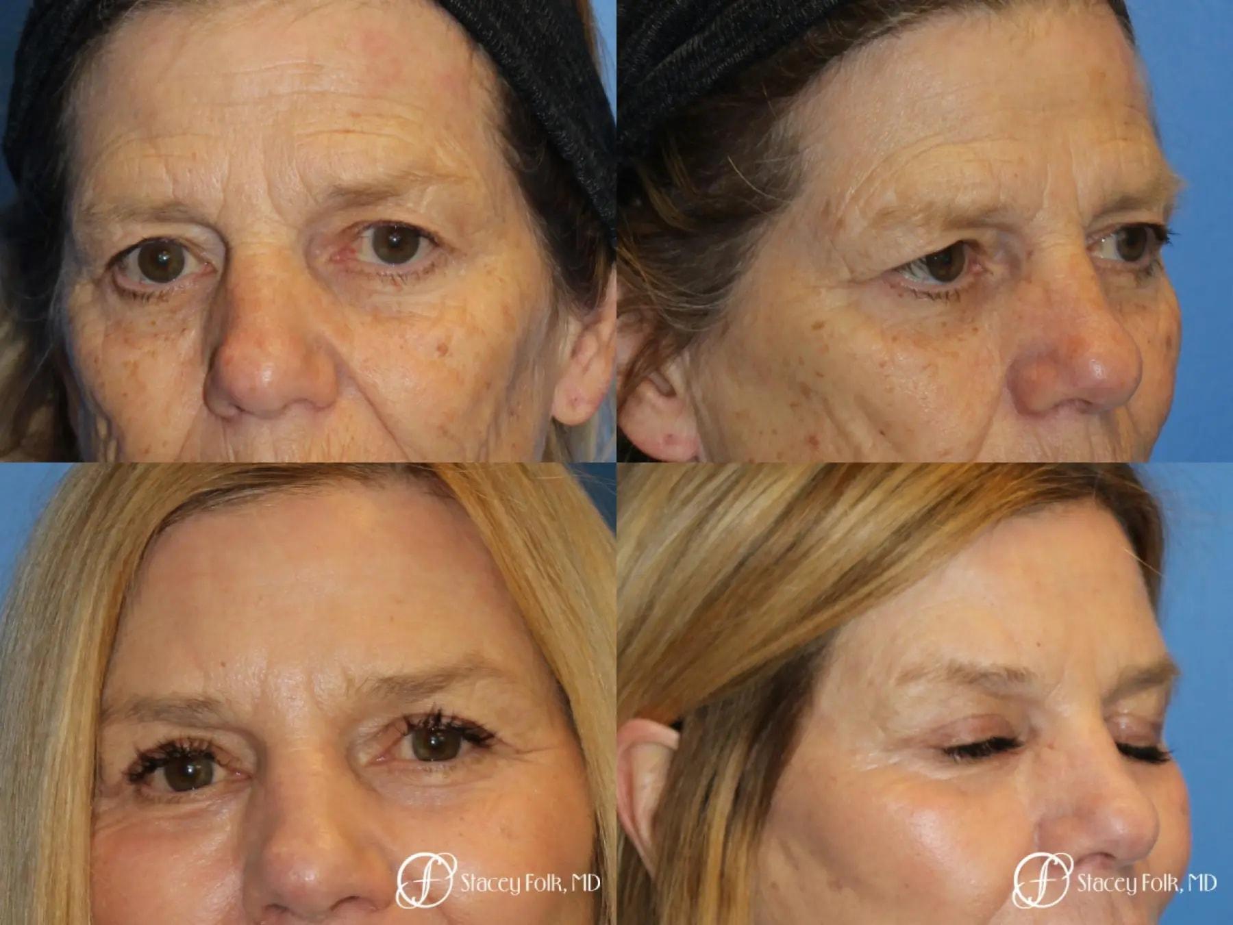Stacey Folk, MD brow lift result — Denver, CO