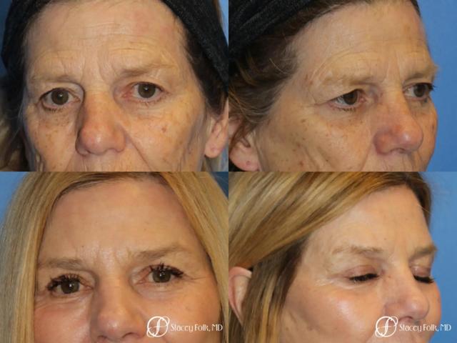 Brow Lift result at Stacey Folk, MD in Denver, CO