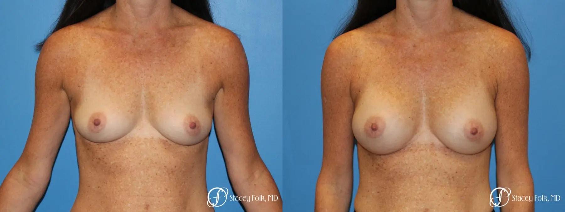 Stacey Folk, MD breast augmentation result — Denver, CO