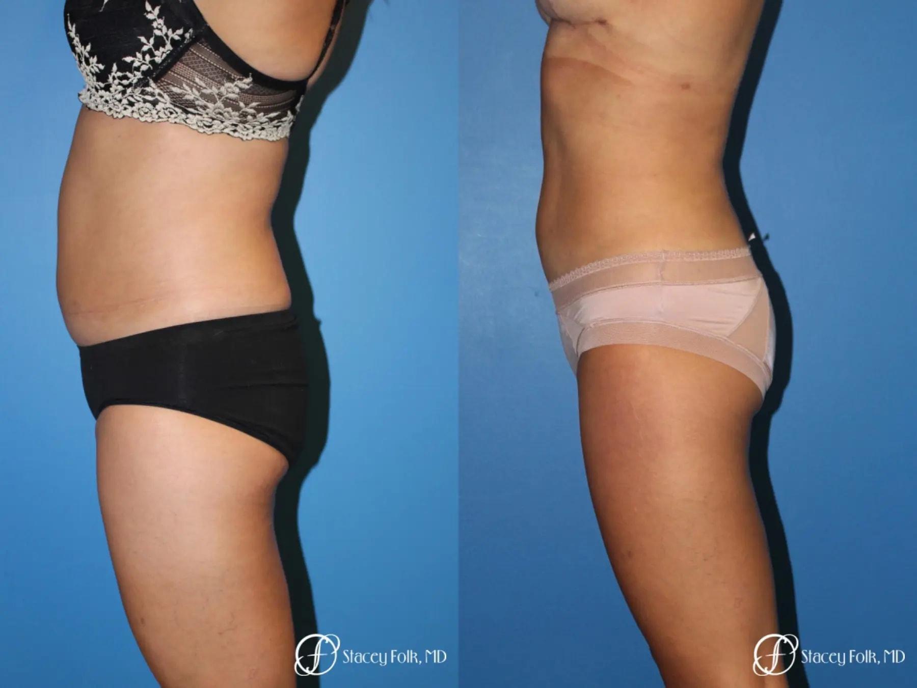 Stacey Folk, MD liposuction result — Denver, CO