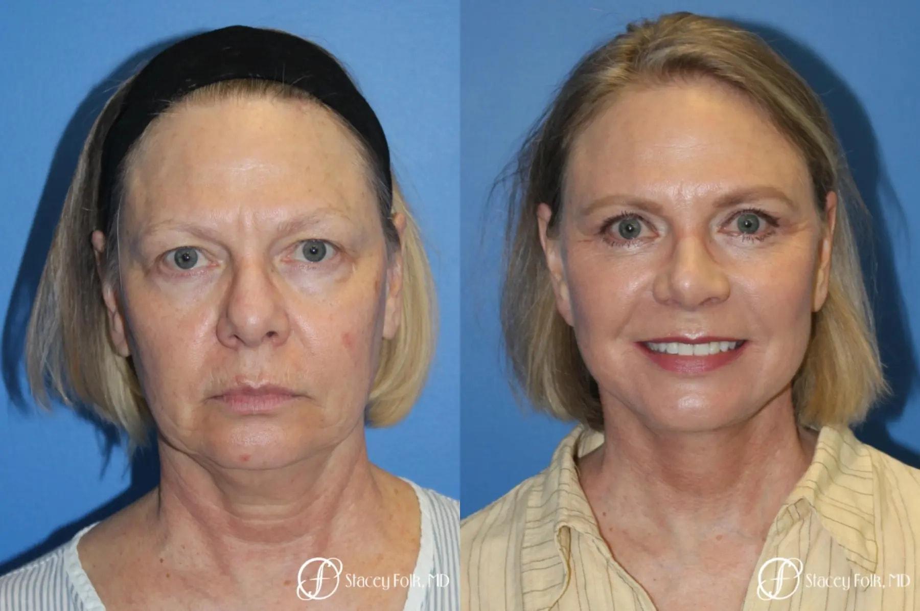 Stacey Folk, MD facelift result — Denver, CO