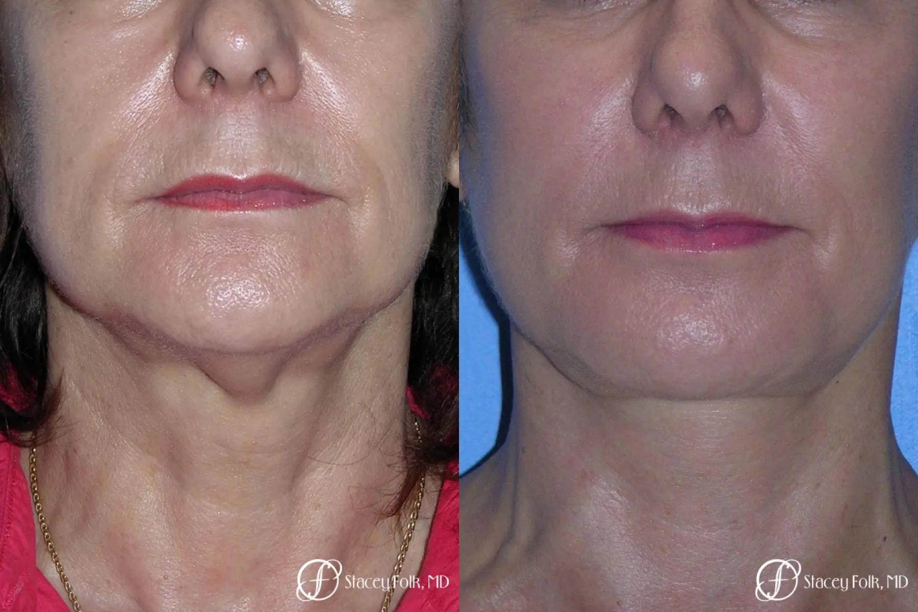 Stacey Folk, MD facelift result — Denver, CO