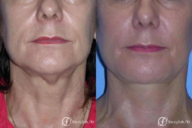 Neck Lift result at Stacey Folk, MD in Denver, CO