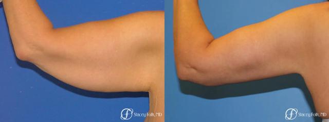 Arm Lift result at Stacey Folk, MD in Denver, CO