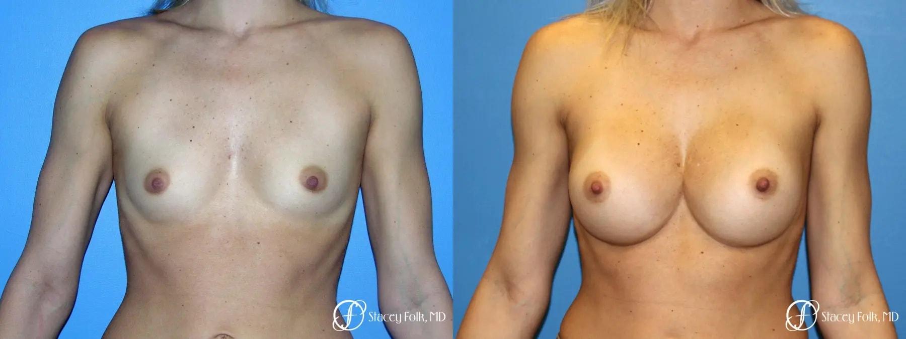 Stacey Folk, MD breast augmentation result — Denver, CO