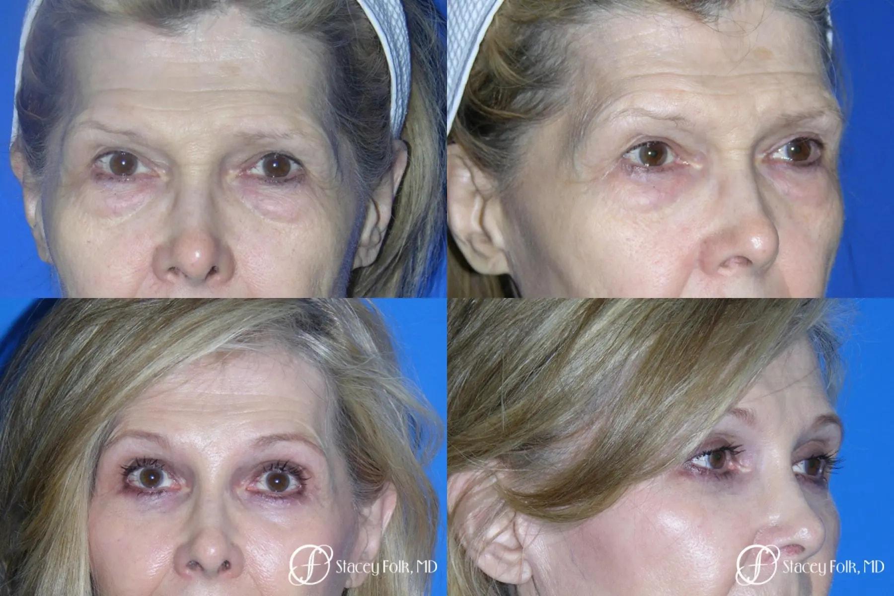 Stacey Folk, MD brow lift result — Denver, CO