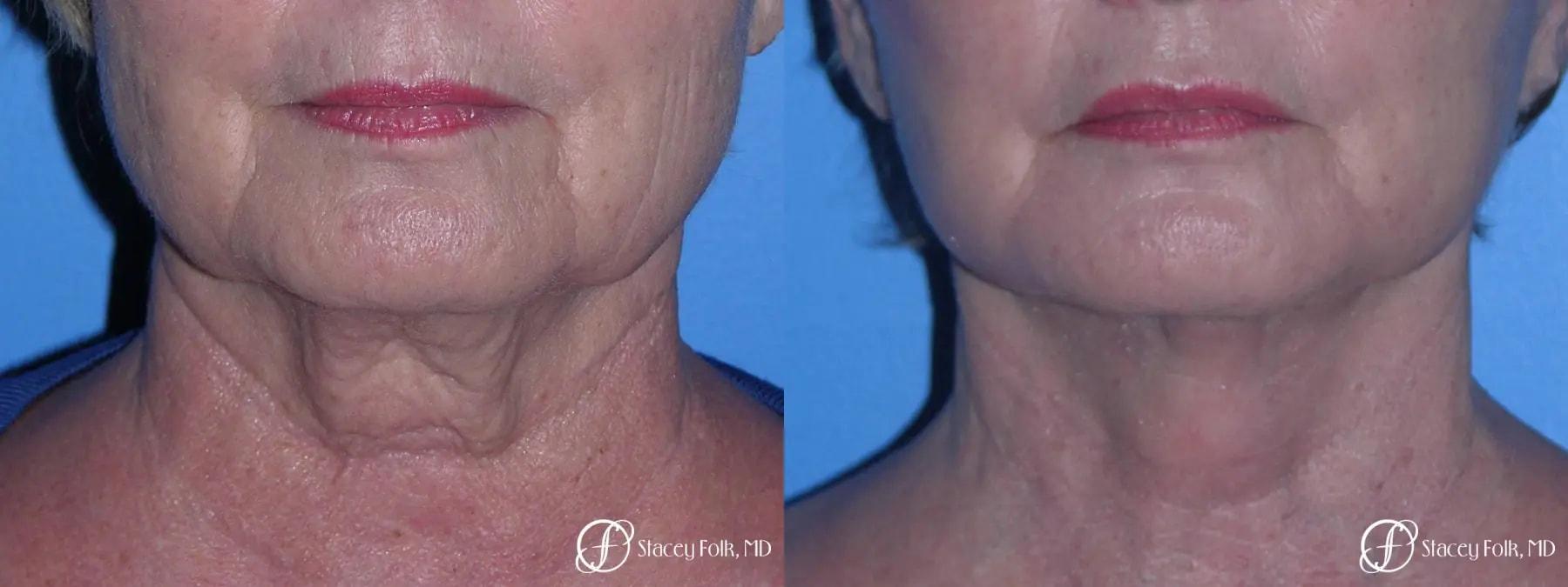 Stacey Folk, MD facelift result — Denver, CO