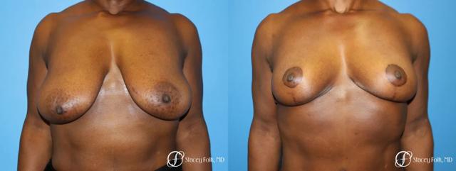 Breast Lift result at Stacey Folk, MD in Denver, CO