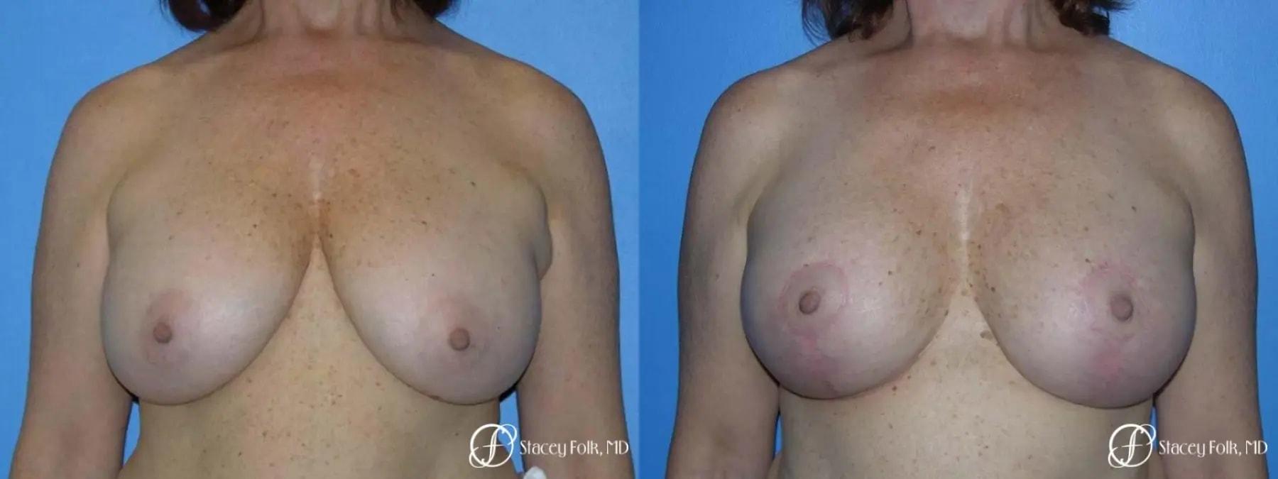 Stacey Folk, MD breast lift result — Denver, CO