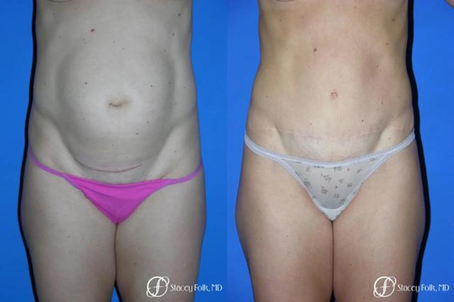 Tummy Tuck result at Stacey Folk, MD in Denver, CO