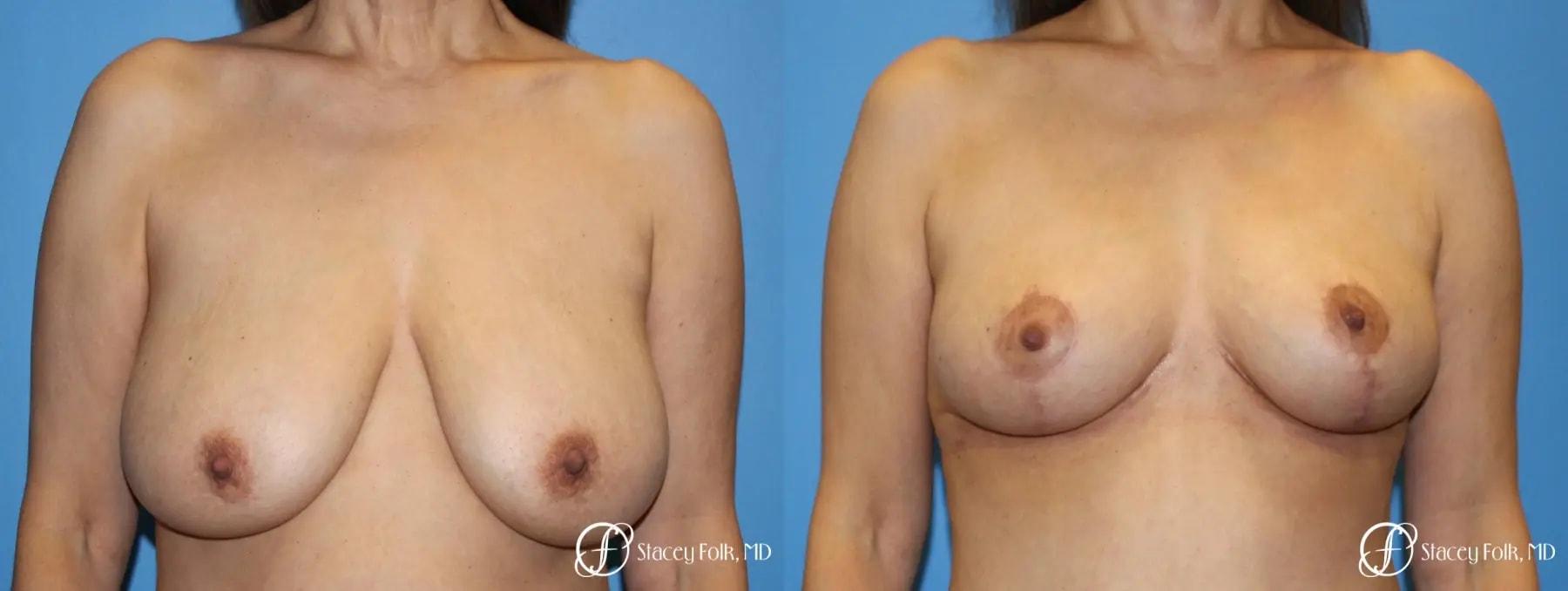Stacey Folk, MD breast lift result — Denver, CO