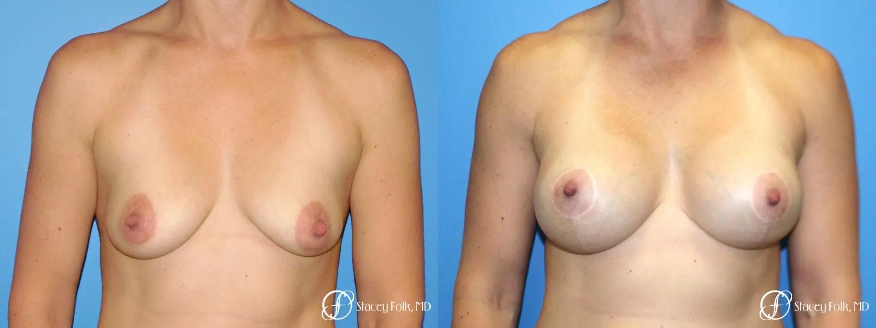 Stacey Folk, MD breast augmentation result — Denver, CO