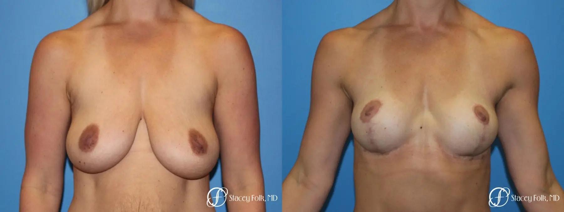 Stacey Folk, MD breast lift result — Denver, CO